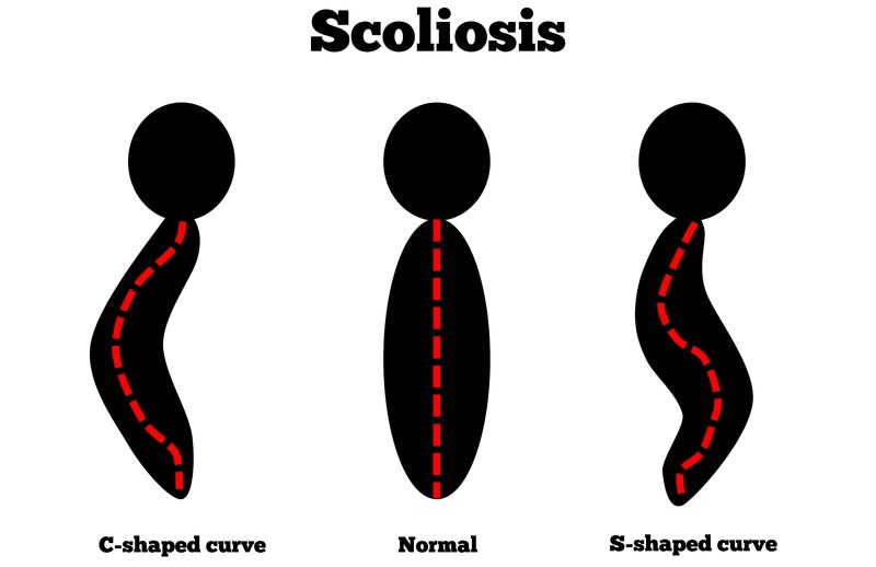 Charlotte, NC scoliosis treatment